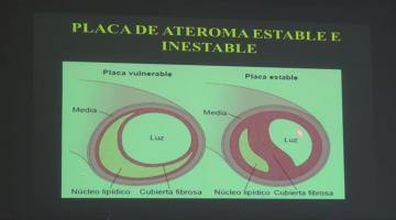 Fisipato 2017 28 de Marzo Cardiopatía Isquémica