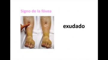 Fisiopatología 2021. Inflamación Aguda.