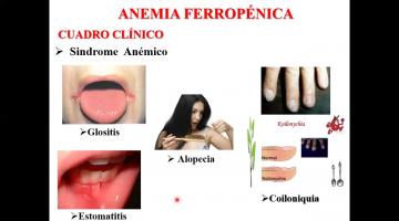 Fisiopatología 2021. Síndrome Anémico.